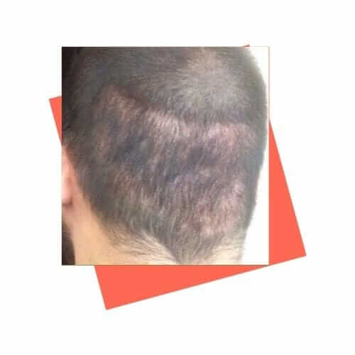 overharvested donor area after hair transplant