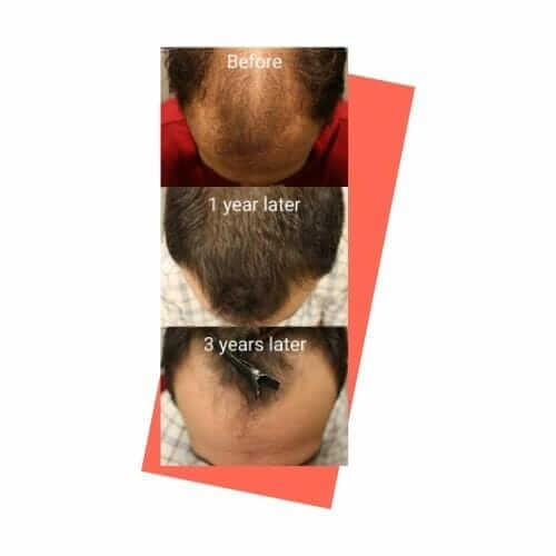 Long Term Hair Transplant Failure (3 Years)