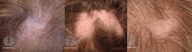 Lichen Planopilaris on real person's scalp