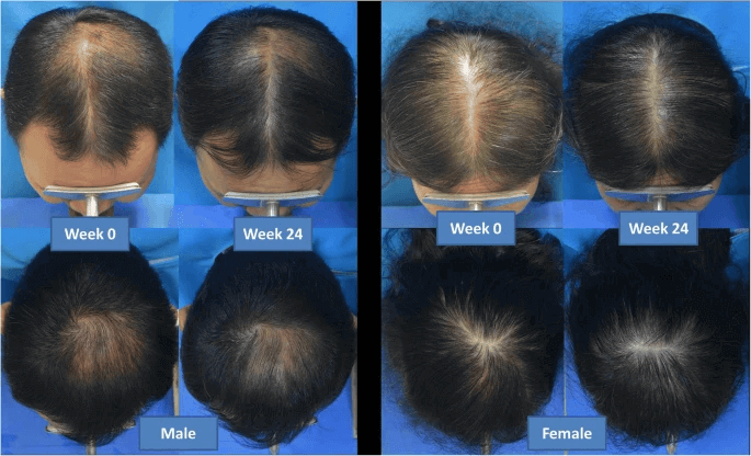 low level laser therapy hair loss