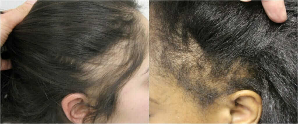 traction alopecia uneven hairline