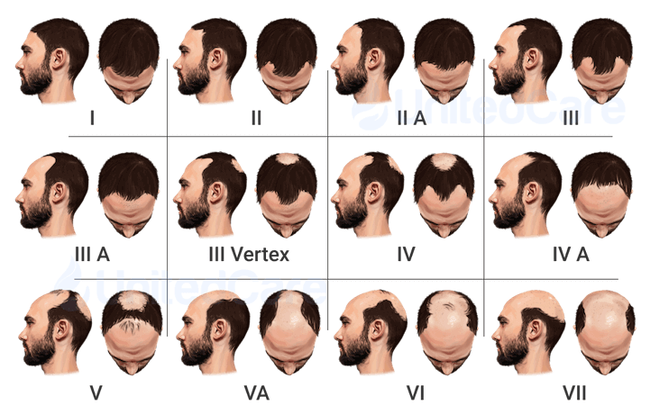 norwood scale for male pattern balding
