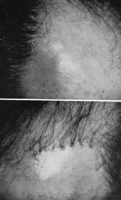 The left and right frontal scalp of Dr. Orentreich’s patient. The right side is intact; the left is with hair plugs. 