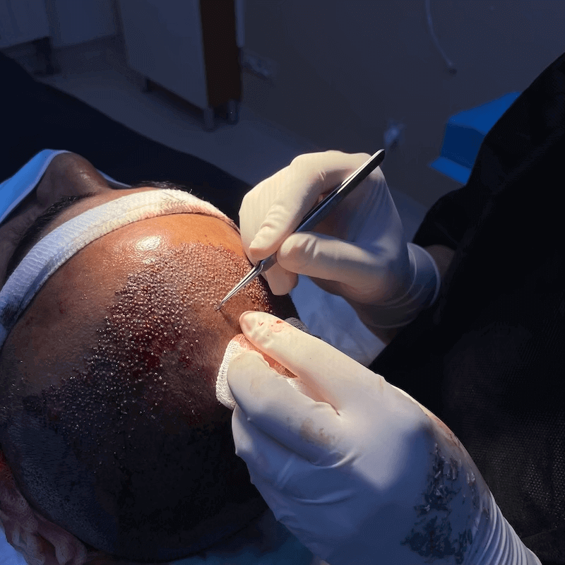 Sapphire FUE Incisions