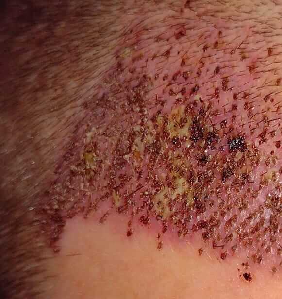Post hair transplant infection on hairline