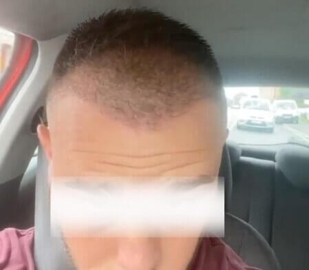 unitedcare hair transplant 3 months after surgery