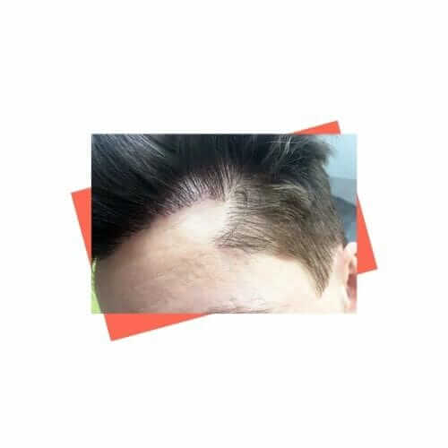 Unnatural hairline after failed hair transplant