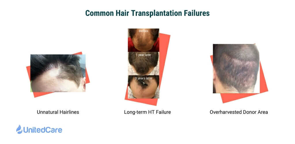 hair transplant failure surgery