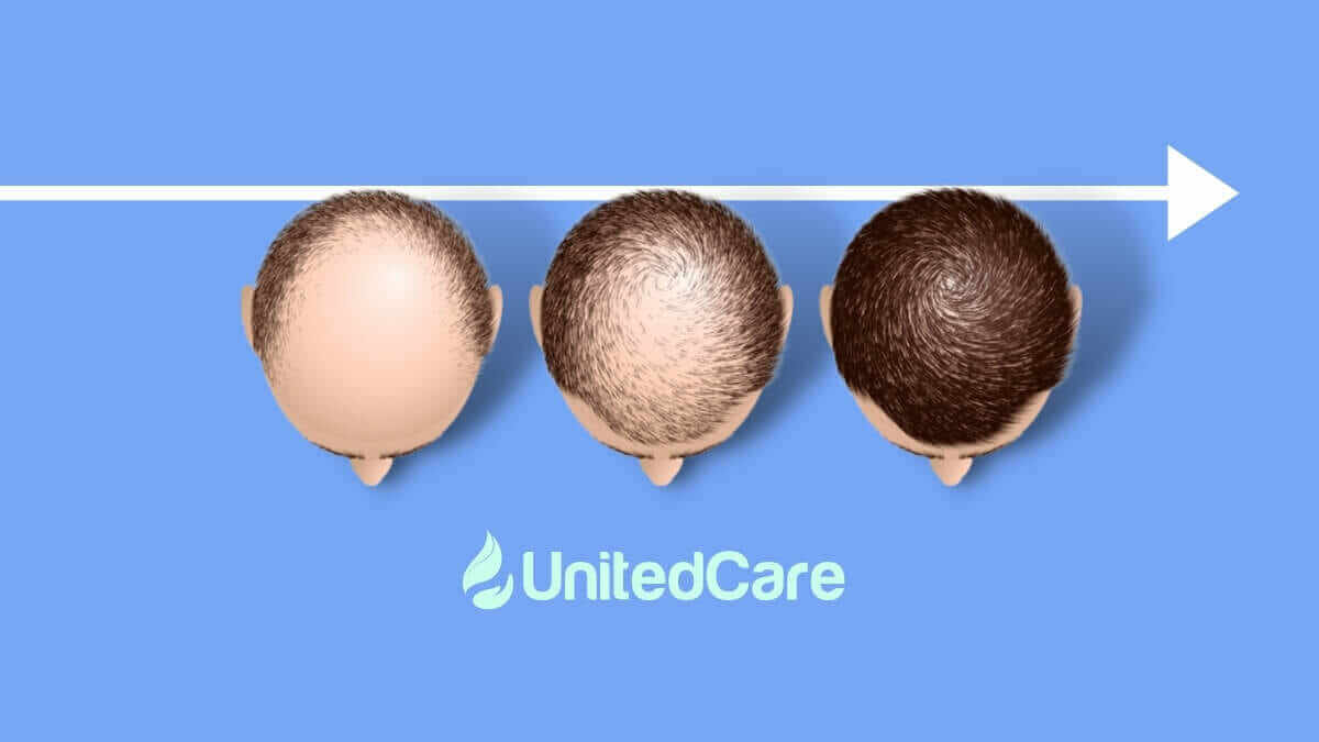 hair transplant in UnitedCare clinic Turkey