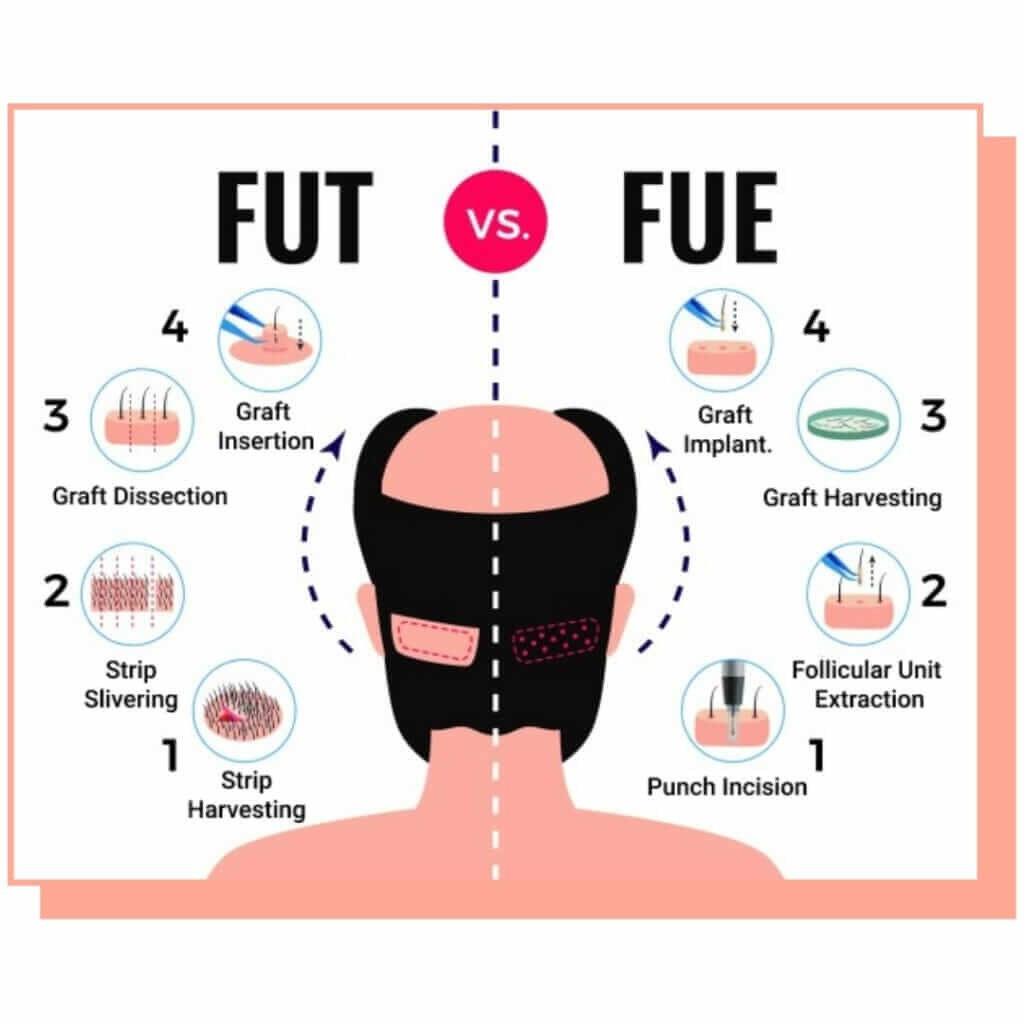 fut vs fue hair transplantation