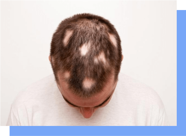 alopecia areata hair loss sign
