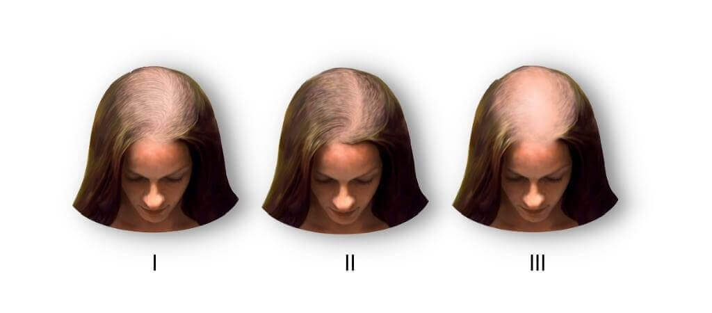 female pattern balding signs