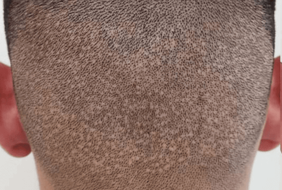 Hair transplant failure caused visible scars on the back of the head