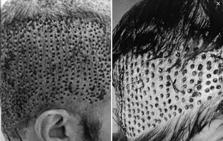 Hair transplant trypophobia trigger (improper, old technique)