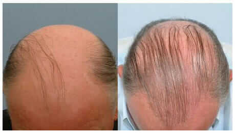 A hair transplant patient with a large balding and limited donor areas