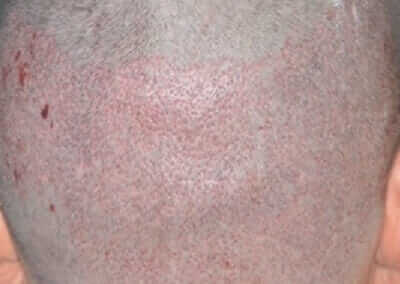 The result of proper diameter micro-punch in hair transplant surgery