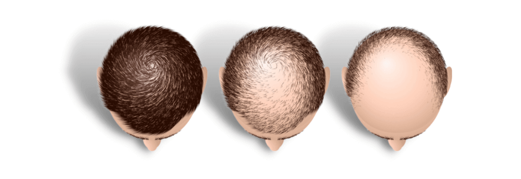 male pattern balding