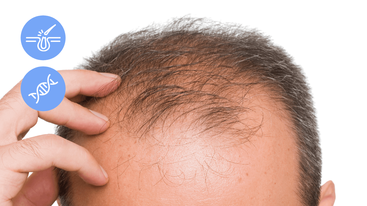 Male Pattern Baldness Androgenetic Alopecia 