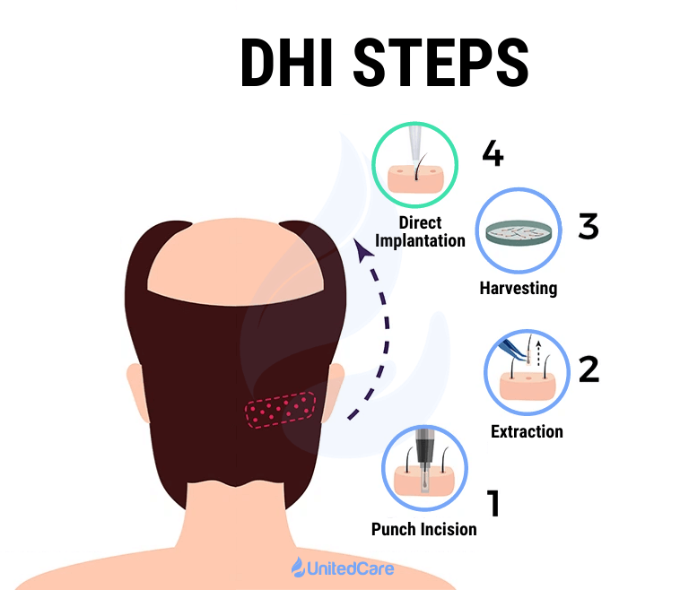 Steps of a DHI (Direct Hair Implantation) Surgery