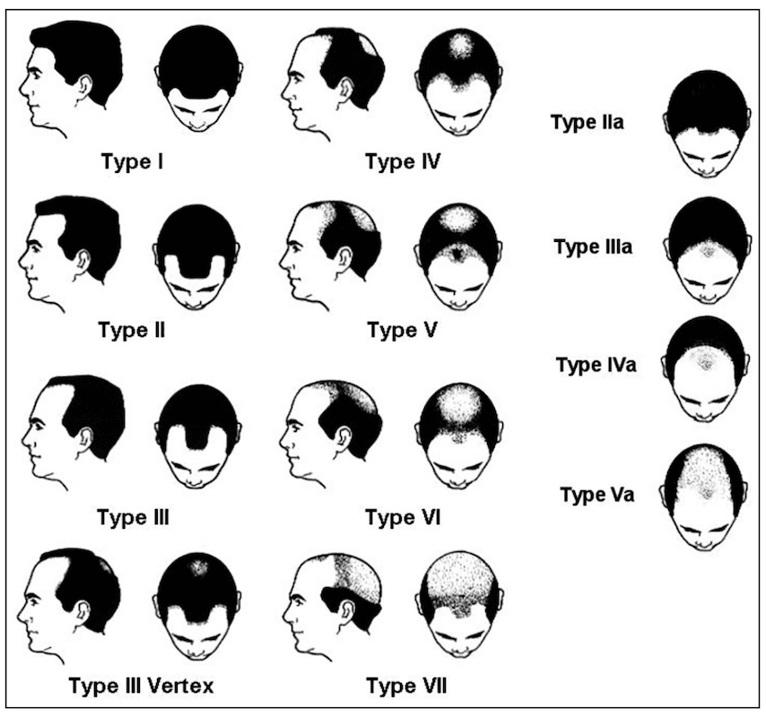 Hamilton-Norwood’s male pattern hair loss classification.