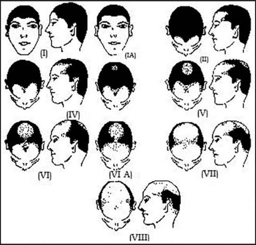 Hamilton classification of male pattern hair loss. Type III due to numerous varieties.
