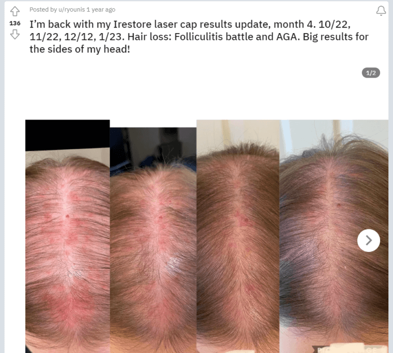 laser cap hair growth