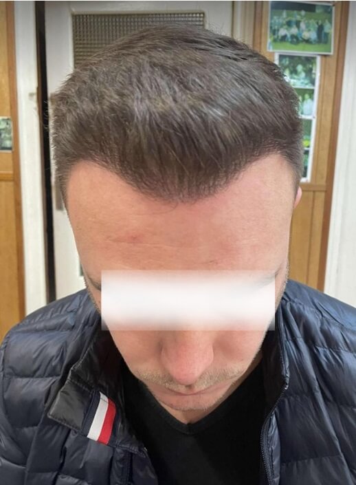 unitedcare hair transplant 6 months after surgery