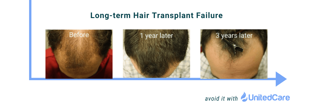 hair transplant uneven hairline