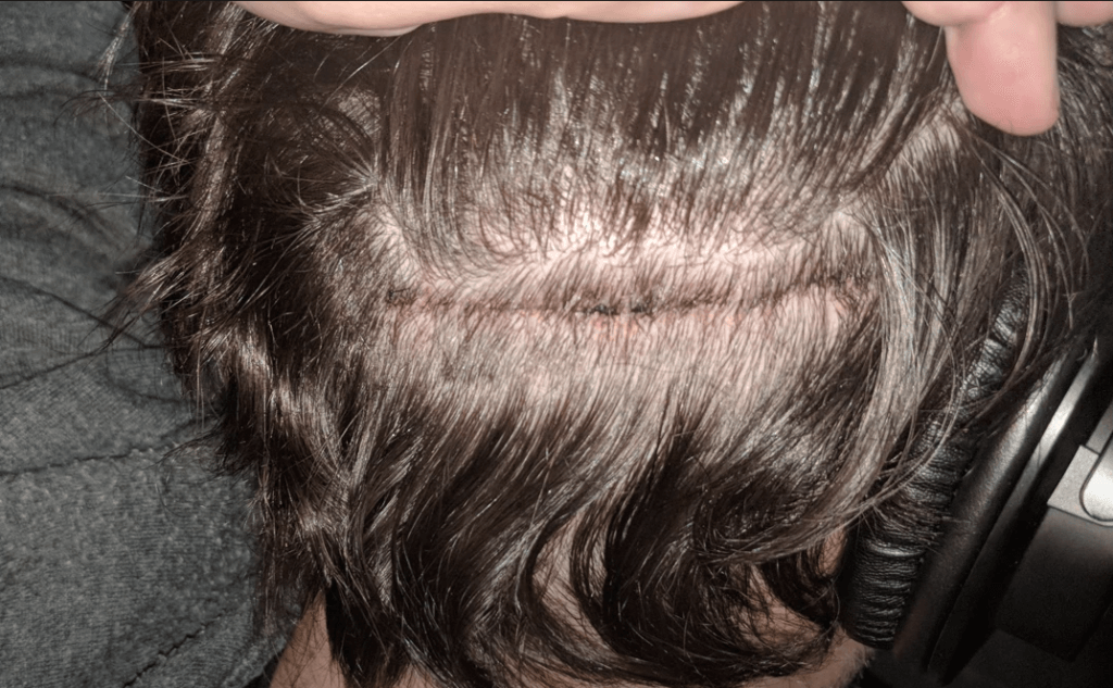 failed hair transplant FUT scar
