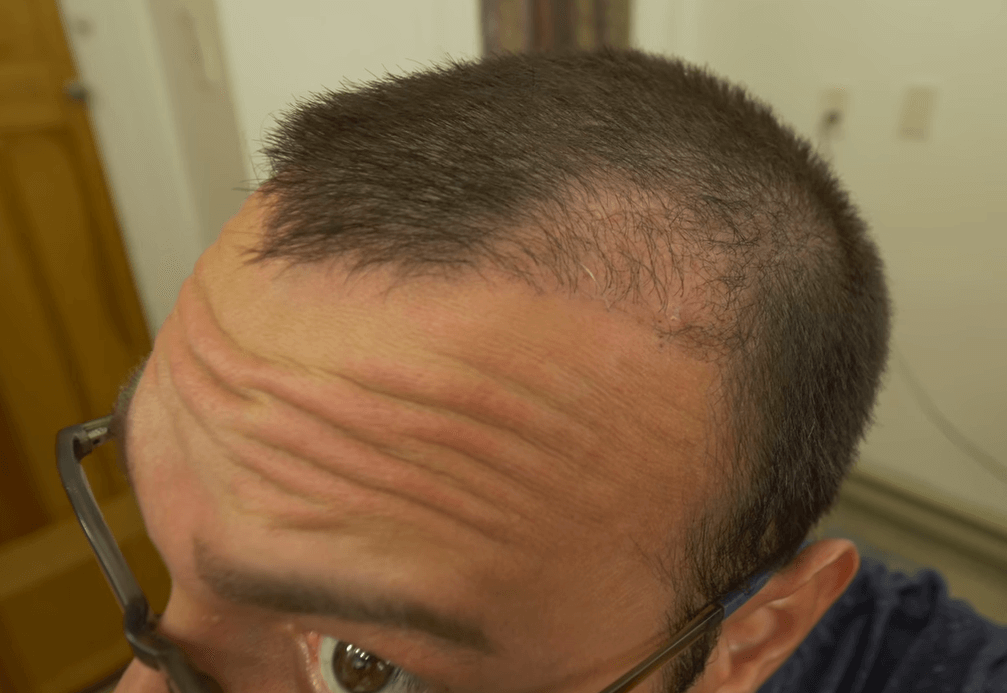 failed hair transplant 4 months after surgery