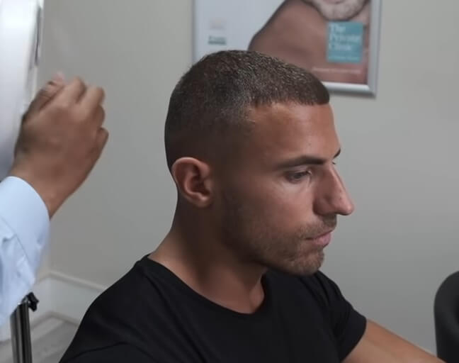 mike thurston hair transplant 6 months after surgery