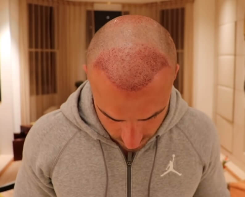 mike thurston hair transplant 2 weeks after surgery