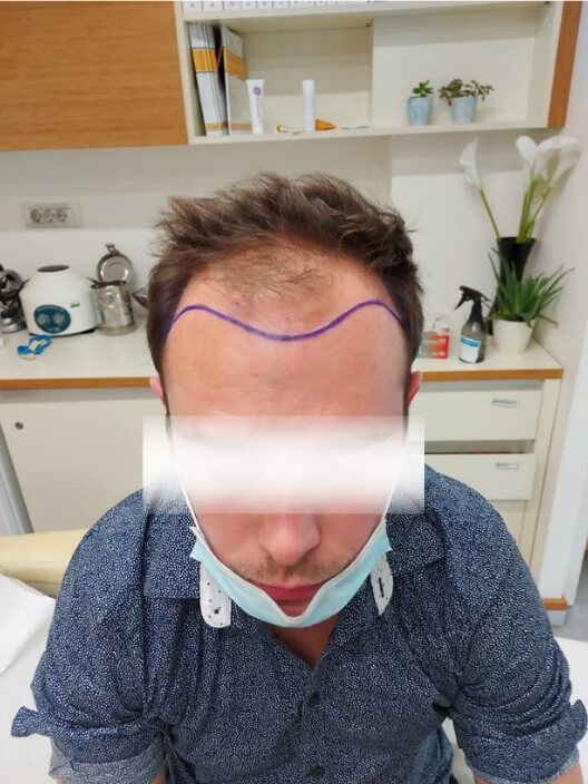 unitedcare hair transplant before the surgery