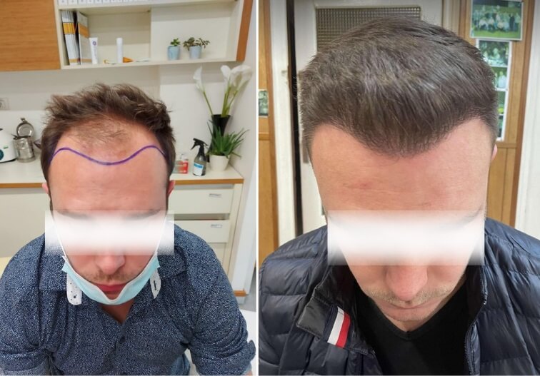 unitedcare hair transplant before and after