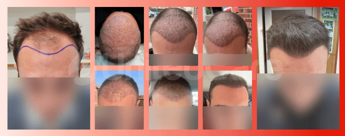 PRP vs hair transplant