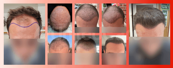 Hair Transplant Results with Finasteride at UnitedCare
