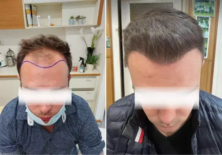 Patient who used Minoxidil after a hair transplant