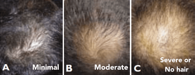 Calculate Grafts + Find out the Worldwide Costs in 30 Seconds