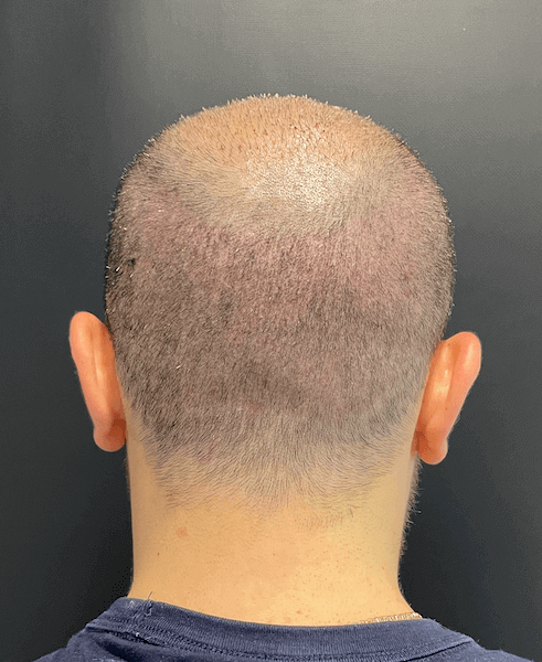 Der Spenderbereich 1 Woche nach der Haartransplantation.